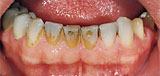Teeth before treatment with KaVo prophylaxis products