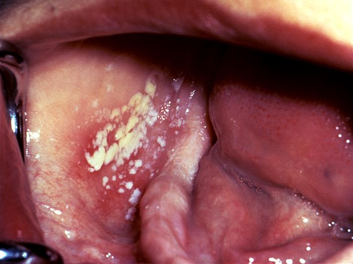 Oral Thrush, Mouth Yeast Infection, AIDS, HIV